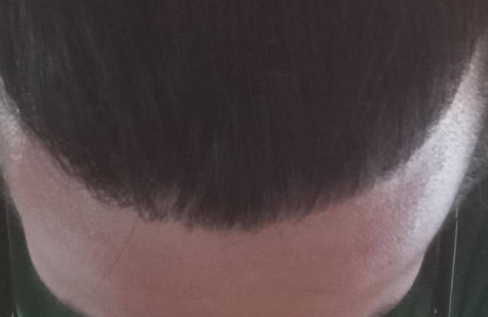 Lord Tetsu DHI hair transplant